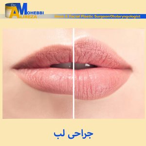 جراحی لب - دکتر محبی