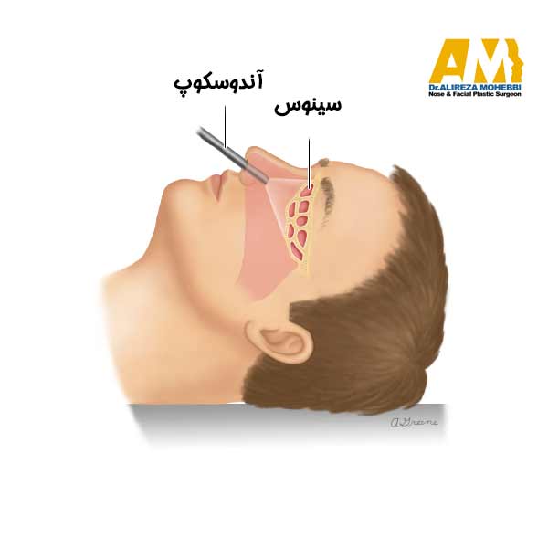 نکات پس از جراحی آندوسکوپی سینوس + دکتر علیرضا محبی