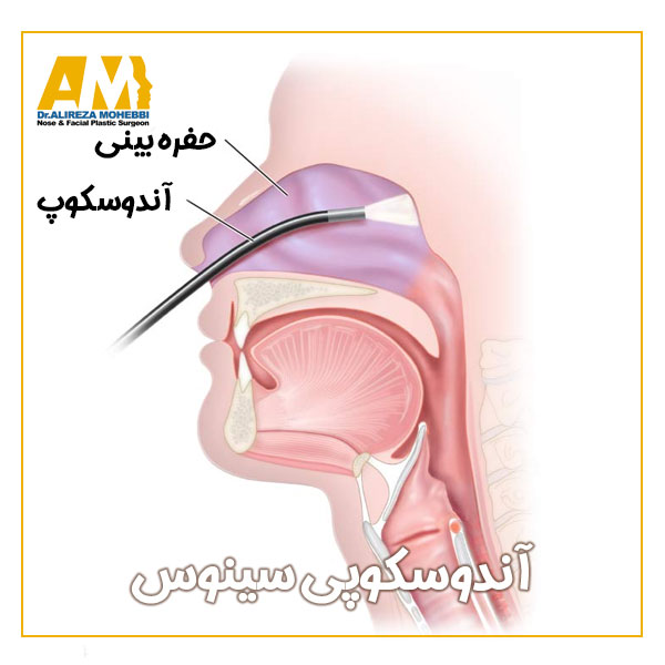 آندوسکوپی سینوس + دکتر علیرضا محبی