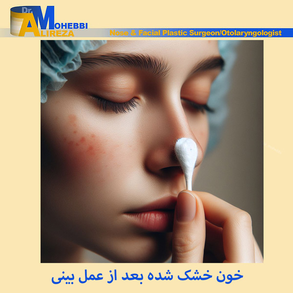 خون خشک شده بعد از عمل بینی - دکتر محبی