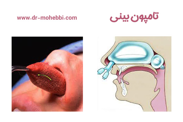 تامپون بینی+ دکتر علیرضا محبی