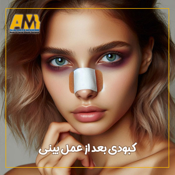 کبودی بعد از عمل بینی + دکتر علیرضا محبی