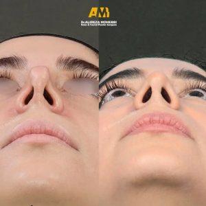 جراحی بینی ترمیمی در تهران + دکتر علیرضا محبی