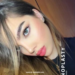 جراحی بینی در تهران + دکتر علیرضا محبی