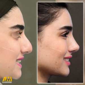 جراحی بینی در تهران + دکتر علیرضا محبی