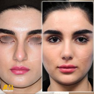 جراحی بینی در تهران + دکتر علیرضا محبی