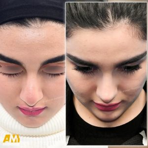 جراحی بینی در تهران + دکتر علیرضا محبی