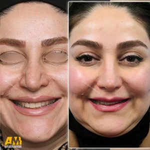 جراحی بینی در تهران + دکتر علیرضا محبی