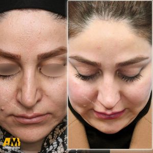 جراحی بینی در تهران + دکتر علیرضا محبی