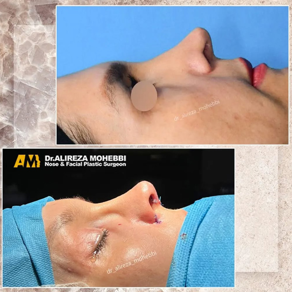 بخیه عمل بینی + دکتر علیرضا محبی