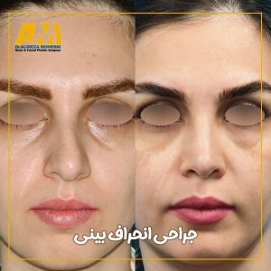 جراحی انحراف بینی + دکتر علیرضا محبی