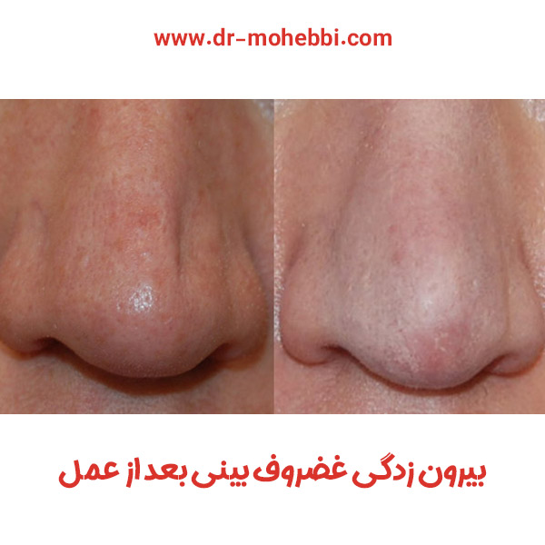 بیرون زدگی غضروف بینی بعد از عمل + دکتر علیرضا محبی