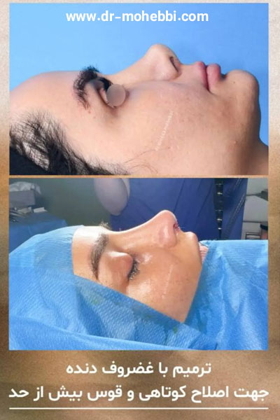 جراحی بینی ترمیمی + دکتر علیرضا محبی