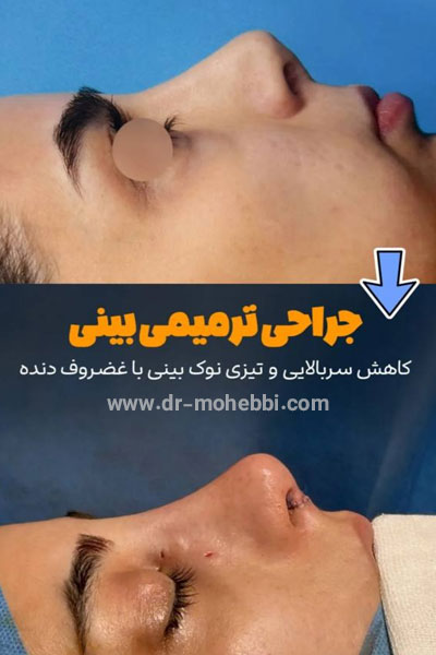 جراحی بینی ترمیمی + دکتر علیرضا محبی