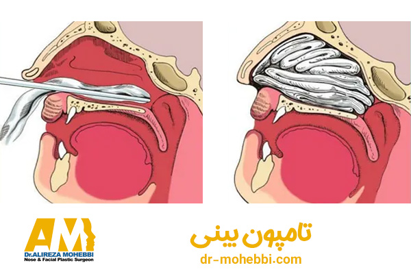 تامپون بینی + دکتر علیرضا محبی