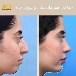 پروتز چانه در تهران + دکتر علیرضا محبی