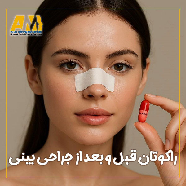 راکوتان قبل و بعد از جراحی بینی + دکتر علیرضا محبی