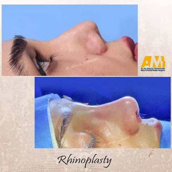 ورم بعد جراحی بینی + دکتر علیرضا محبی