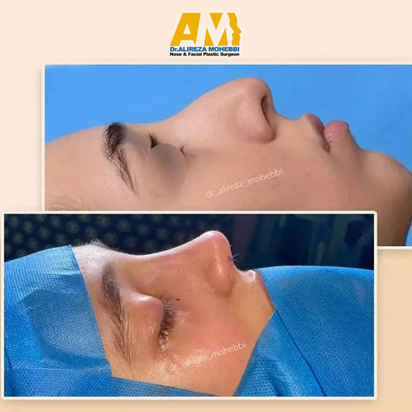 ورم بعد جراحی بینی + دکتر علیرضا محبی