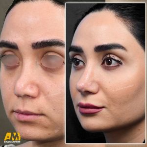 جراحی بینی ترمیمی در تهران + دکتر علیرضا محبی