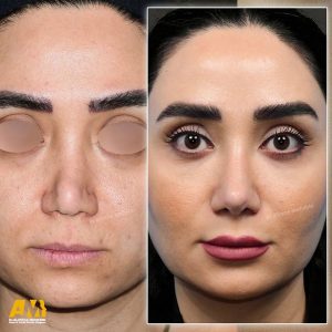 جراحی بینی ترمیمی در تهران + دکتر علیرضا محبی
