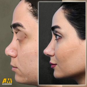 جراحی بینی ترمیمی در تهران + دکتر علیرضا محبی