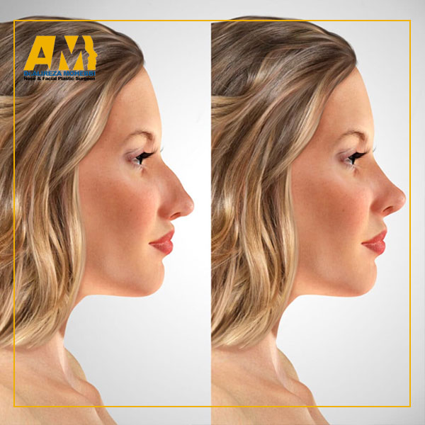 جراحی بینی در تهران + دکتر علیرضا محبی