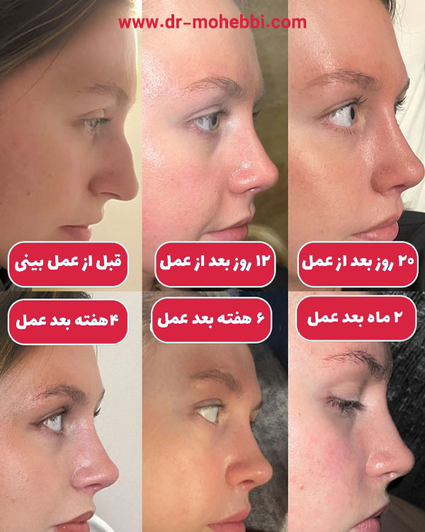 ورم بعد جراحی بینی + دکتر علیرضا محبی