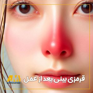 قرمزی بینی بعد از عمل + دکتر علیرضا محبی
