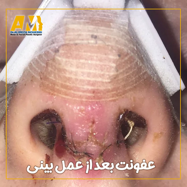 عفونت بعد از عمل بینی + دکتر علیرضا محبی