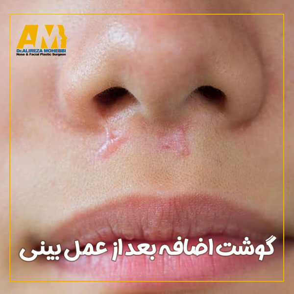 درمان گوشت اضافه بعد از عمل بینی + دکتر علیرضا محبی
