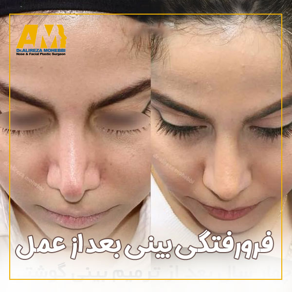 فرورفتگی بینی بعد از عمل + دکتر علیرضا محبی