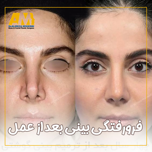 فرورفتگی بینی بعد از عمل + دکتر علیرضا محبی
