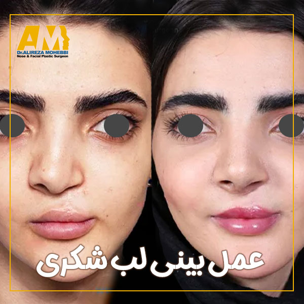عمل بینی لب شکری + دکتر علیرضا محبی
