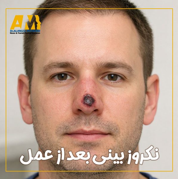 نکروز بینی + دکتر علیرضا محبی