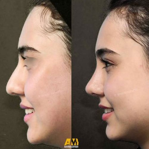Rhinoplasty-100