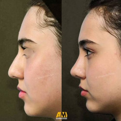 Rhinoplasty-101