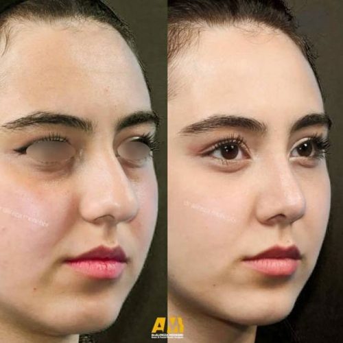 Rhinoplasty-103