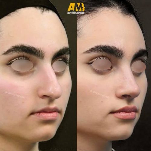 Rhinoplasty-104