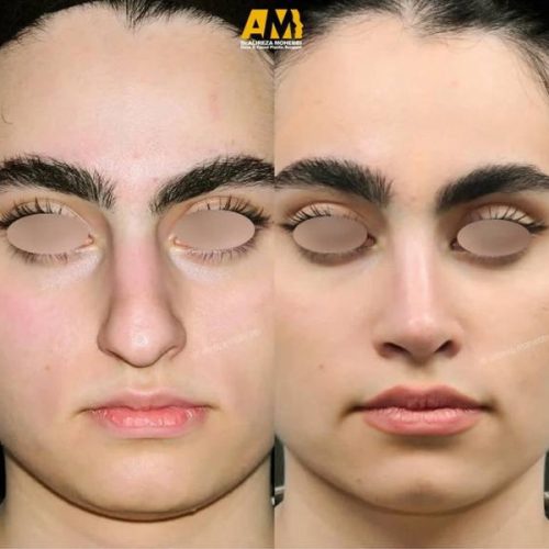 Rhinoplasty-105