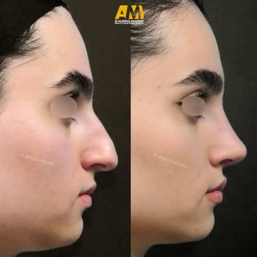Rhinoplasty-106