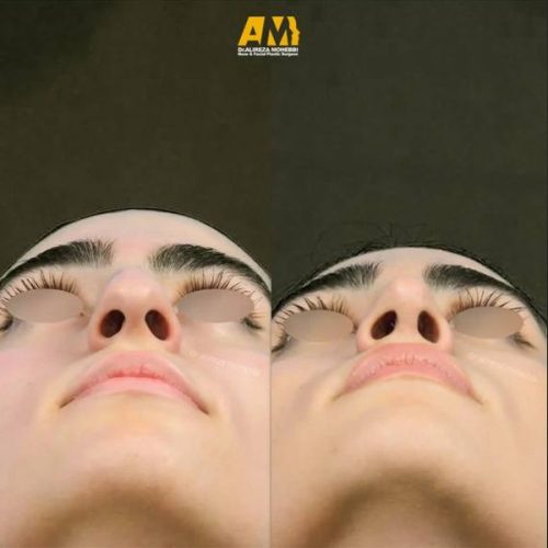 Rhinoplasty-107