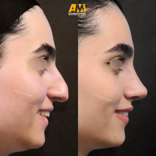 Rhinoplasty-108