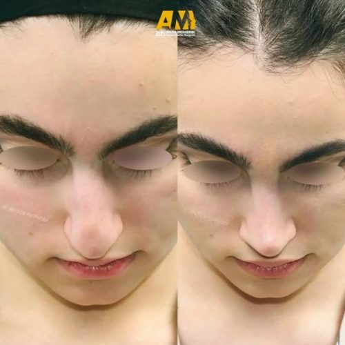 Rhinoplasty-109