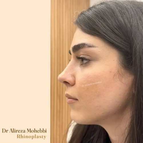 Rhinoplasty-110