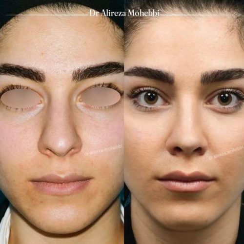 Rhinoplasty-111