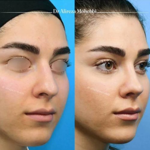 Rhinoplasty-112