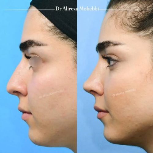 Rhinoplasty-113