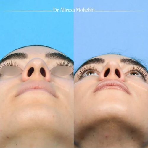 Rhinoplasty-114