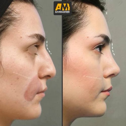 Rhinoplasty-115